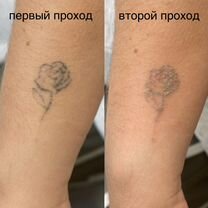 Лазерное удаление тату / татуажа бровей Москва, Москва