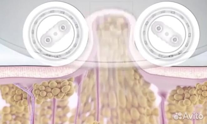 Аппаратная эстетика Lpg-oil,RF- лифтинг, узк