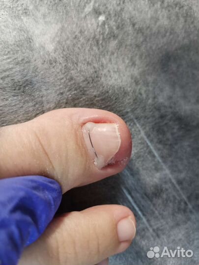 Подолог, вросший ноготь, грибок, зачистка