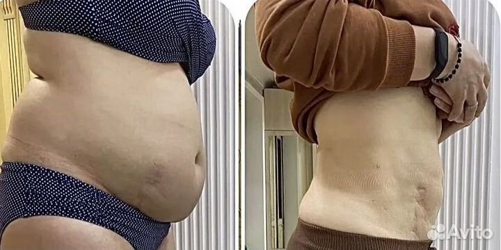 Плоский живот - размер за 1 процедуру