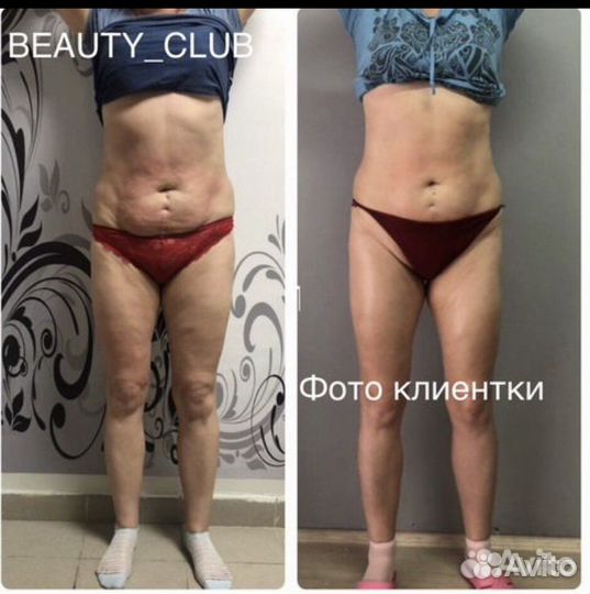 Антицелюлитный Массаж New на аппарате Turbo G 8