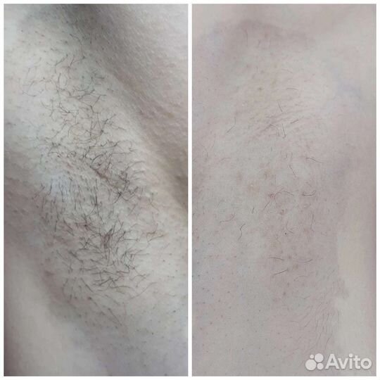 Электроэпиляция