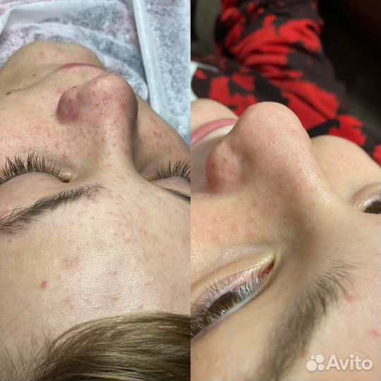 Механическая чистка лица