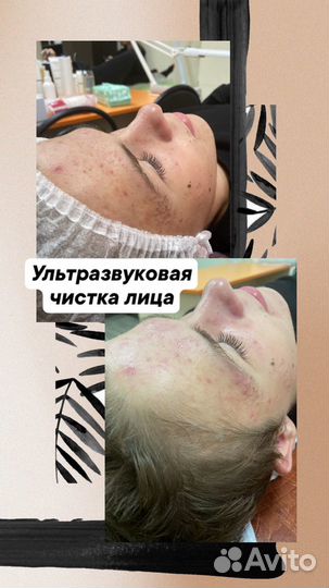 Комбинированная чистка,пилинги,уход за лицом