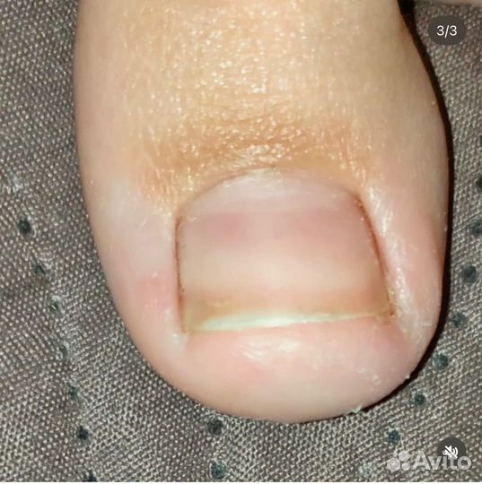 Педикюр подолог