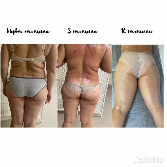 Аппаратный +Вакуумный массаж + RF-лифтинг