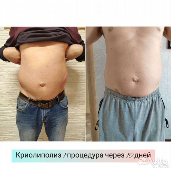 Криолиполиз 360