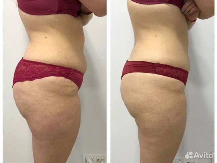 Снижения веса /LPG и Прессотерапия сеанс