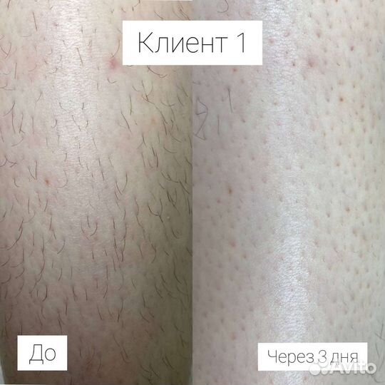 Электроэпиляция: голени