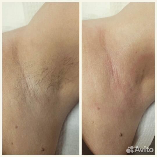 Лазерная эпиляция диодный лазер