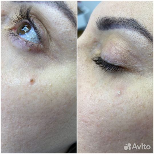 Удаление папилом, фибром, родинок