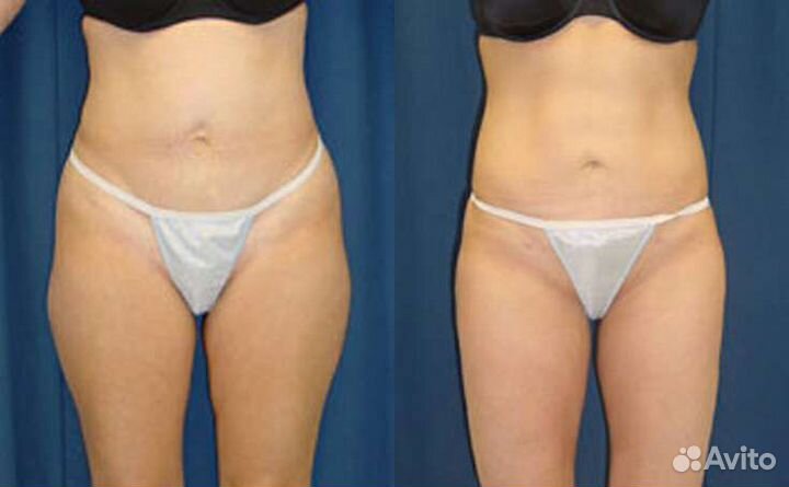 Криолиполиз