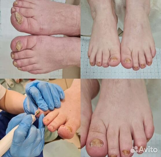 Подолог. Вросший ноготь. Грибок. Титановая нить