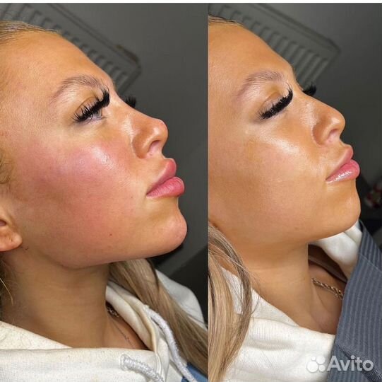 Углы Джоли. Услуги косметолога в рассрочку