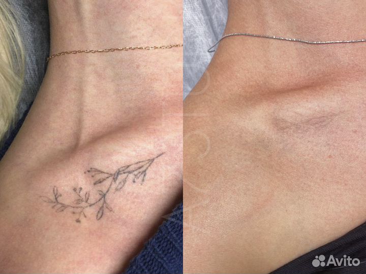 Удаление татуировок