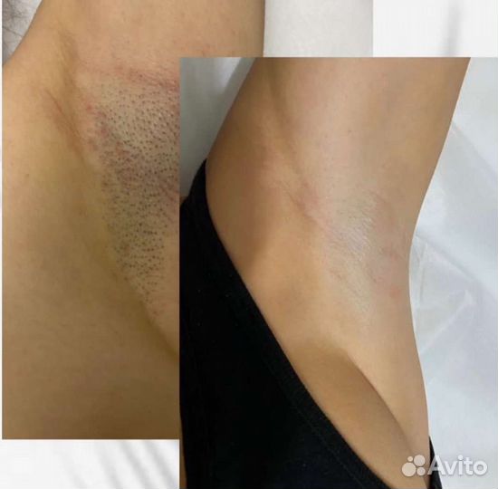 Лазерная эпиляция