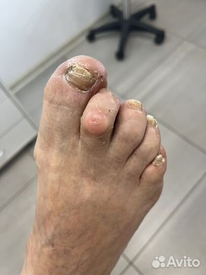 Лечебный педикюр выезд на дом подолог
