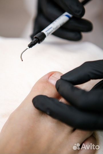 Вросшие ногти. Подолог.Смарт педикюр