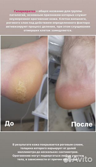 Подолог. Медицинский педикюр