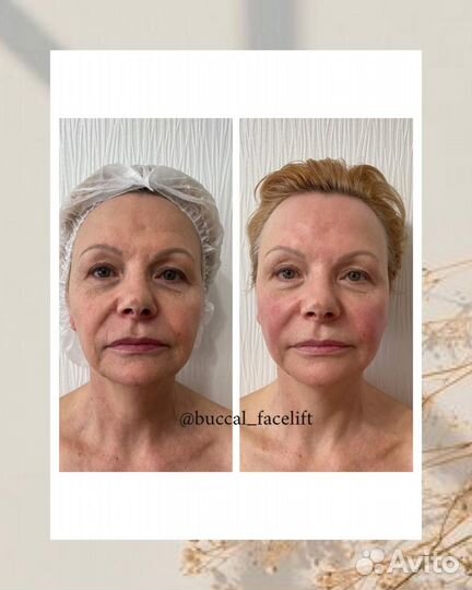 Буккальный массаж лица