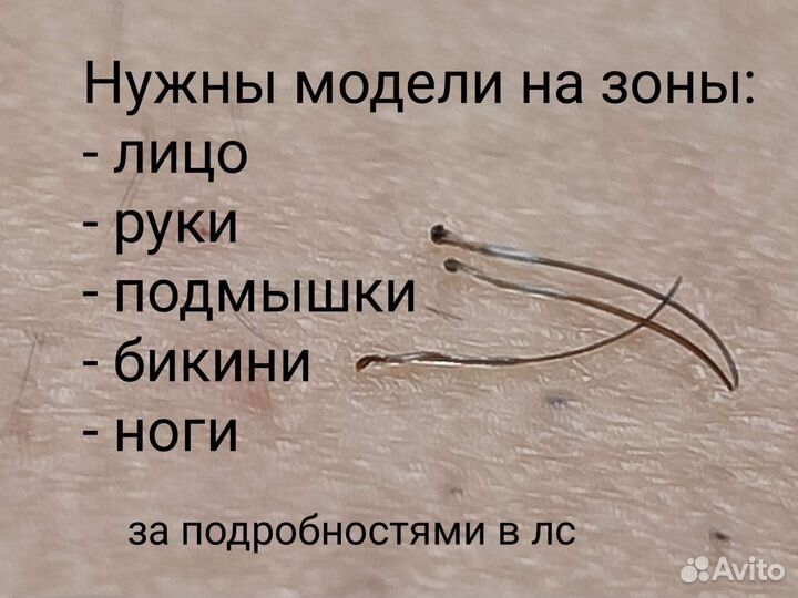 Электроэпиляция