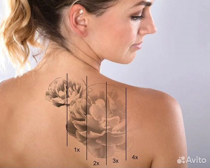 Лазерное удаление тату и татуажа