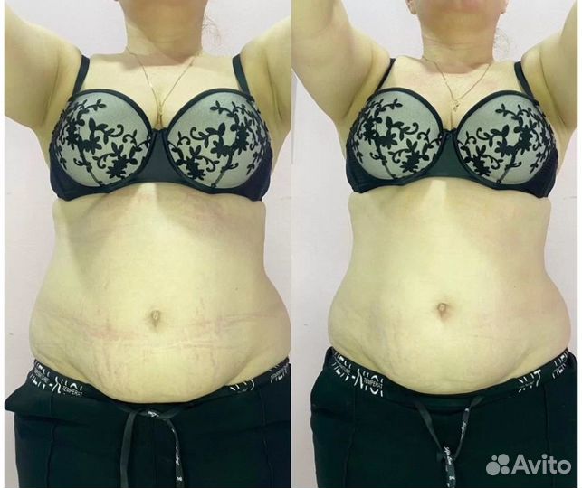 Плоский живот - размер за 1 процедуру в Казани