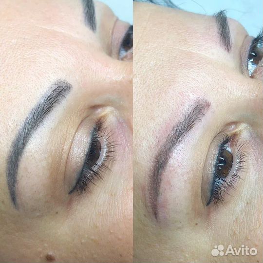 Удаление татуажа лазером, удаление тату