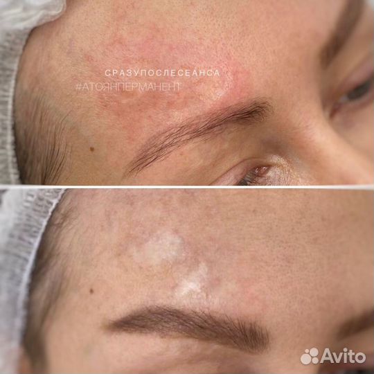 Реконструктивная дермопигментация