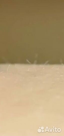 Удаление папиллом