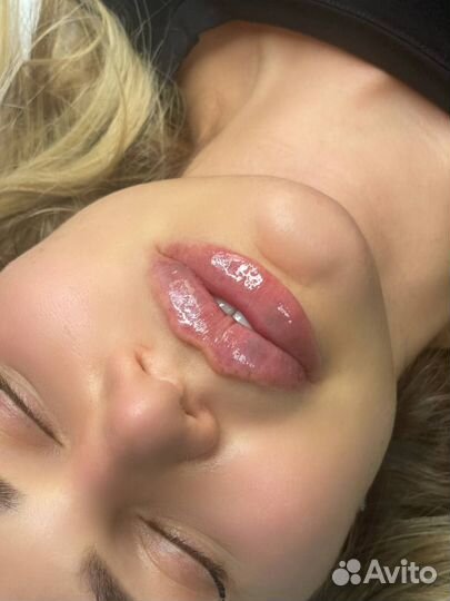 Инъекции, ботокс лица, губ, межбровье, лоб