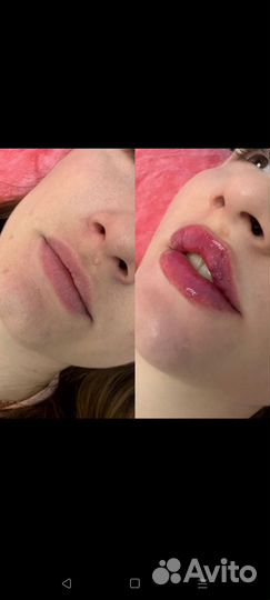 Услуги косметолога контурная пластика