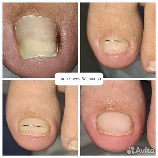 Лечебный педикюр подолог