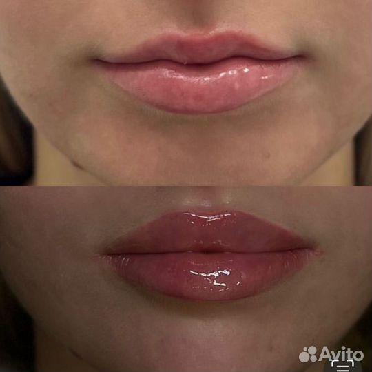 Контурная пластика губ