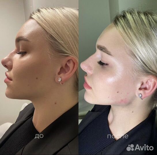 Коррекция подбородка,скулы,профиль Джоли