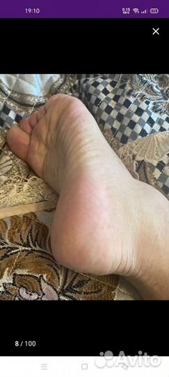 Удаление ороговевший кожи