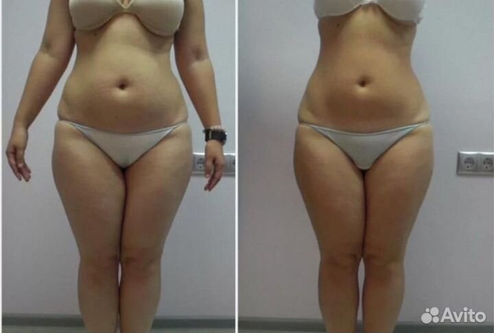 Глубокий антицеллюлитный Субдермальный массаж