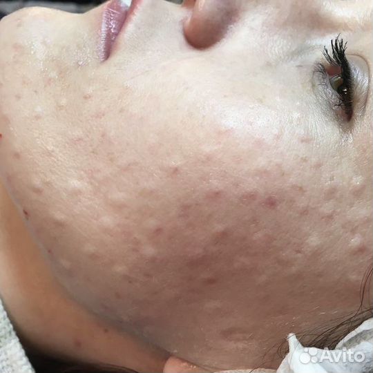 Мезотерапия кожи головы