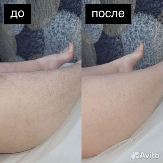 Депиляция