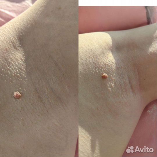Шугаринг и Восковая депиляция