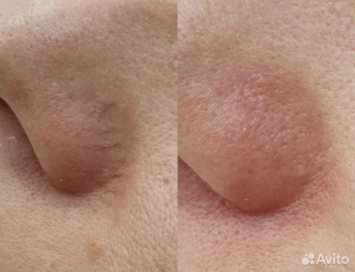 Лазерная эпиляция, элос эпиляция, элос омоложение