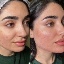 Ботокс Full Face, Видное