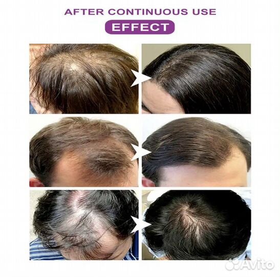 Спрей Против выпадения волос