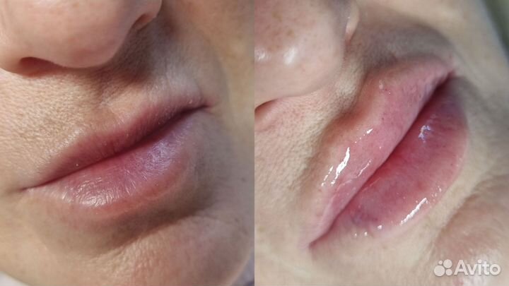 Увеличение губ