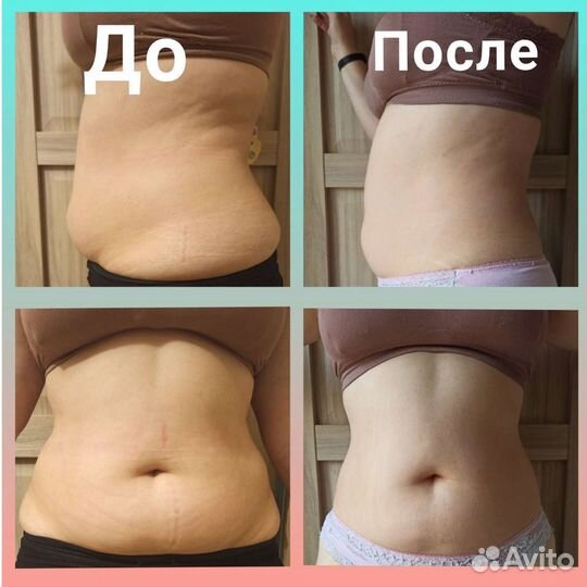 Эстетическое тейпирование тела