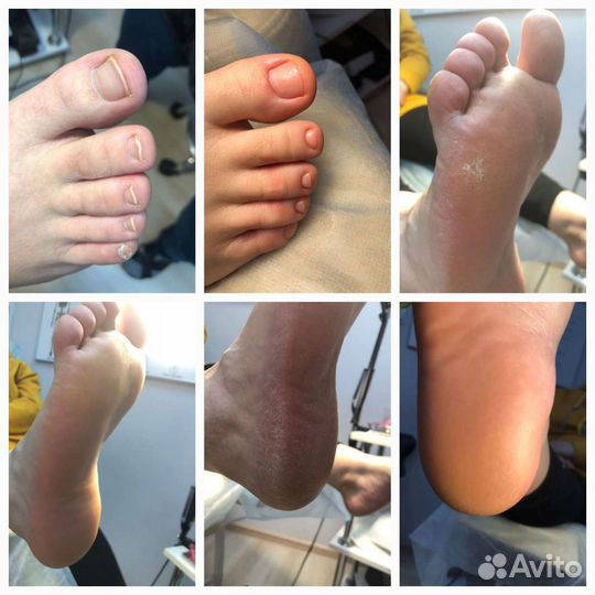 Педикюр, подология