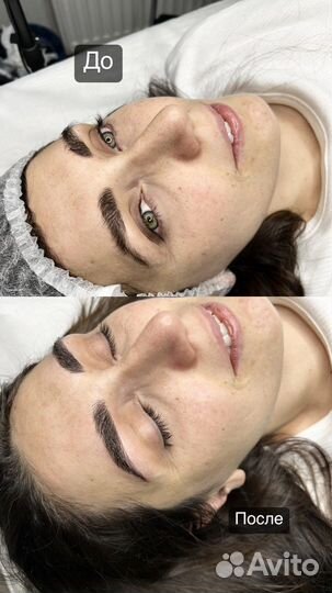 Микроблейдинг