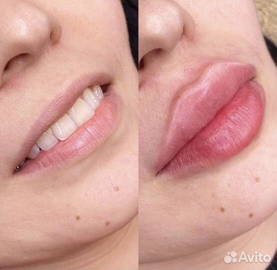 Full face, косметолог обучение, увеличение губ