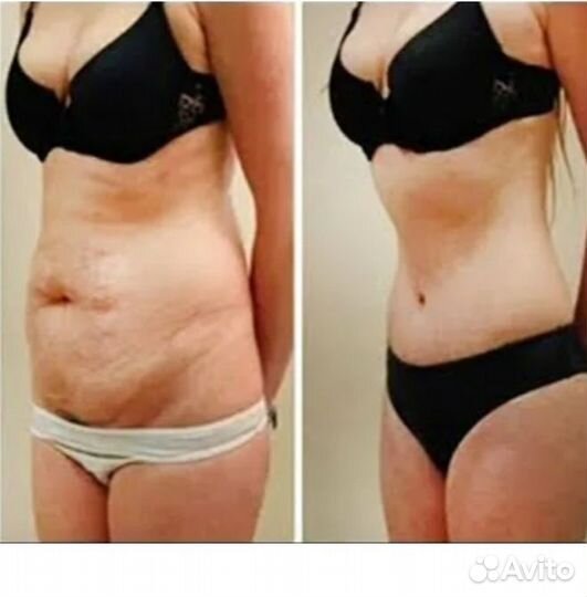 Индибо - Жиротоп, терапия,подтяжка