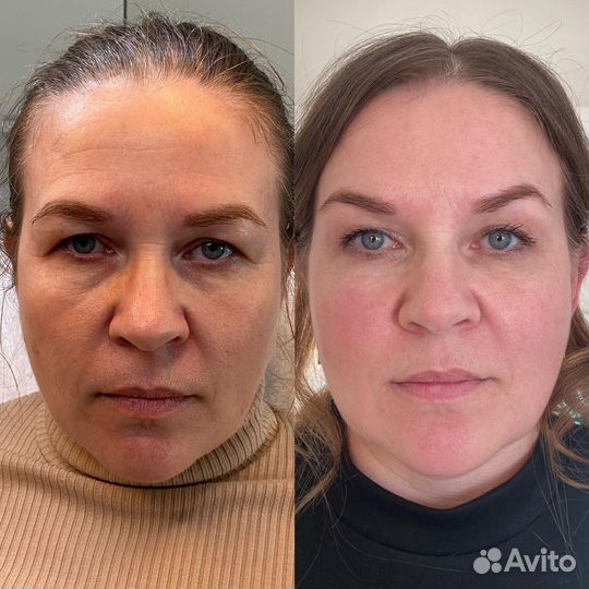 Увеличение губ